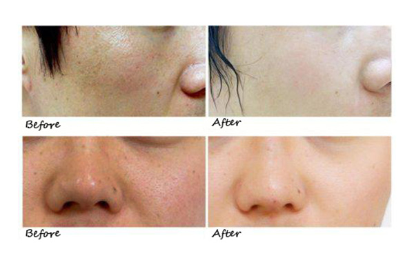 水光針的效果怎么樣?