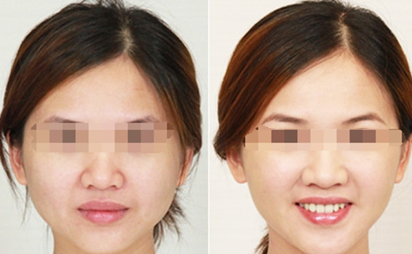 瘦臉針的效果怎么樣？