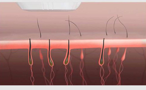 全身脫毛永久的大概需要多少錢？