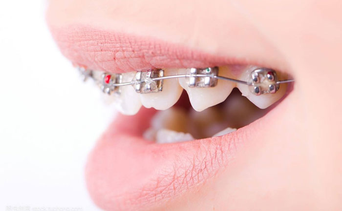 口腔正畸的最佳治療方法？口腔正畸的最佳年齡是多少？