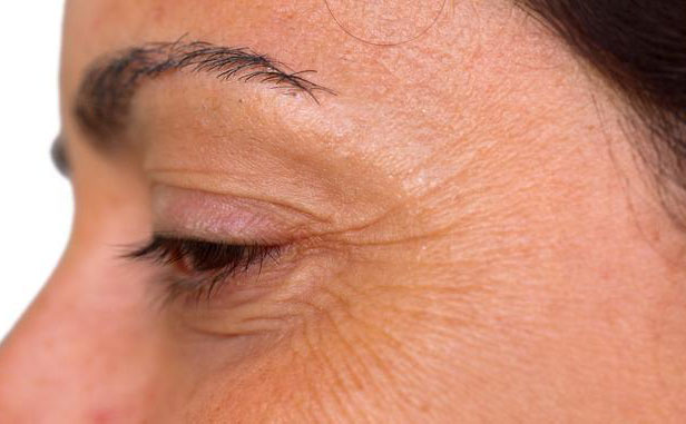 眼角紋怎么消除簡單方法？眼角紋去除要多少錢？