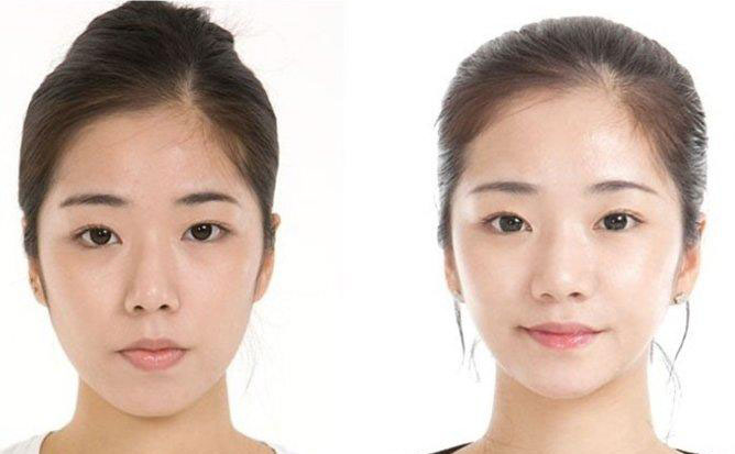 面部吸脂瘦臉的副作用？