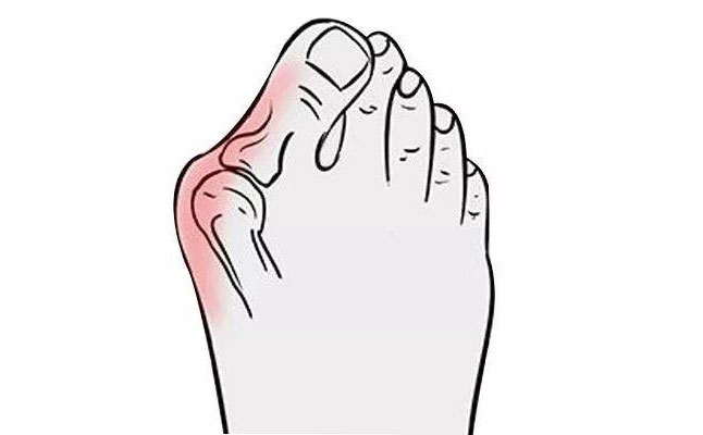 大腳骨矯正手術(shù)多少錢？大腳骨矯正三個月可以恢復(fù)嗎？