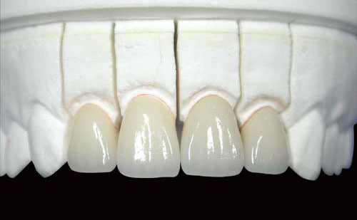 初鈦烤瓷牙