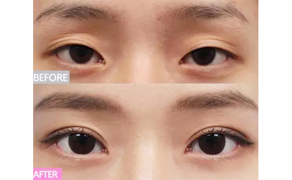 三眼皮是怎么回事?怎么變回雙眼皮?