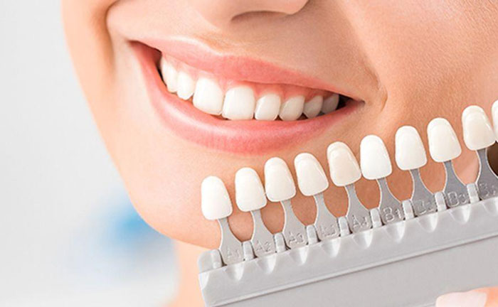 牙齒美白哪種方法好？