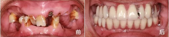 美奧種植牙案例1