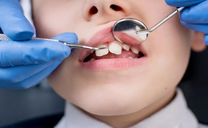 小孩牙齒矯正最佳年齡？小孩牙齒矯正價格多少錢？