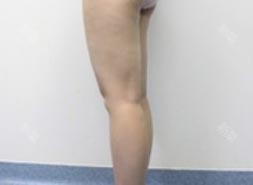 太原時(shí)光整形王國(guó)軍大腿吸脂案例