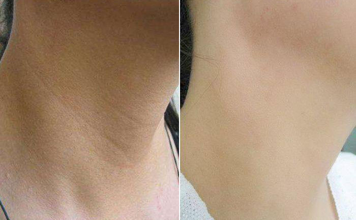 嗨體去頸紋效果怎么樣？