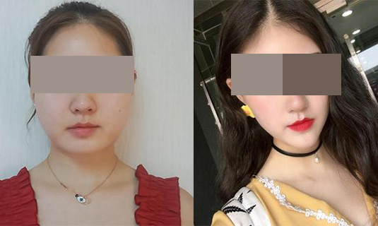 面部吸脂效果對比圖