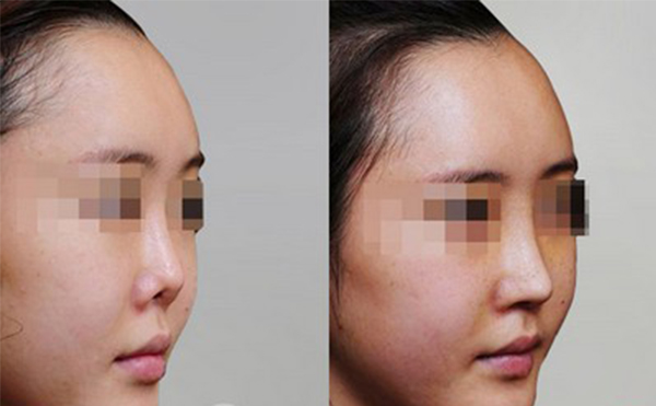修復(fù)后的鼻翼缺損是否真實(shí)？