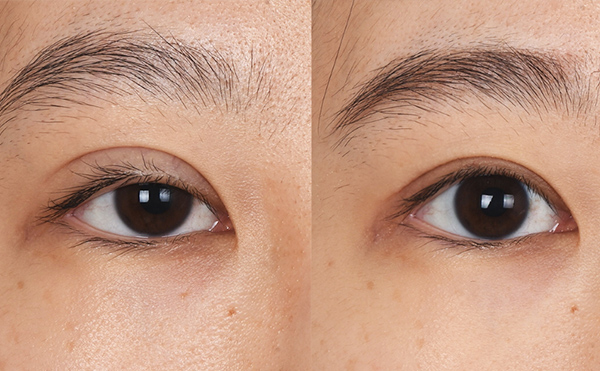 眼部修復(fù)風(fēng)險(xiǎn)大嗎？眼修復(fù)價(jià)格是多少？