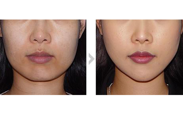 面部吸脂可以多次進(jìn)行嗎？