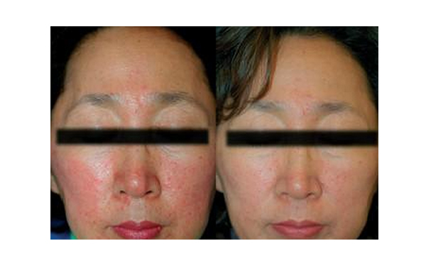 復(fù)合彩光去紅血絲痛不痛？