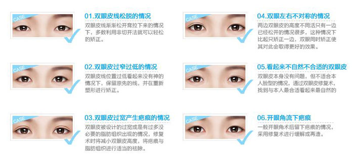 雙眼皮修復手術(shù)成功率高嗎？雙眼皮修復的最佳時間
