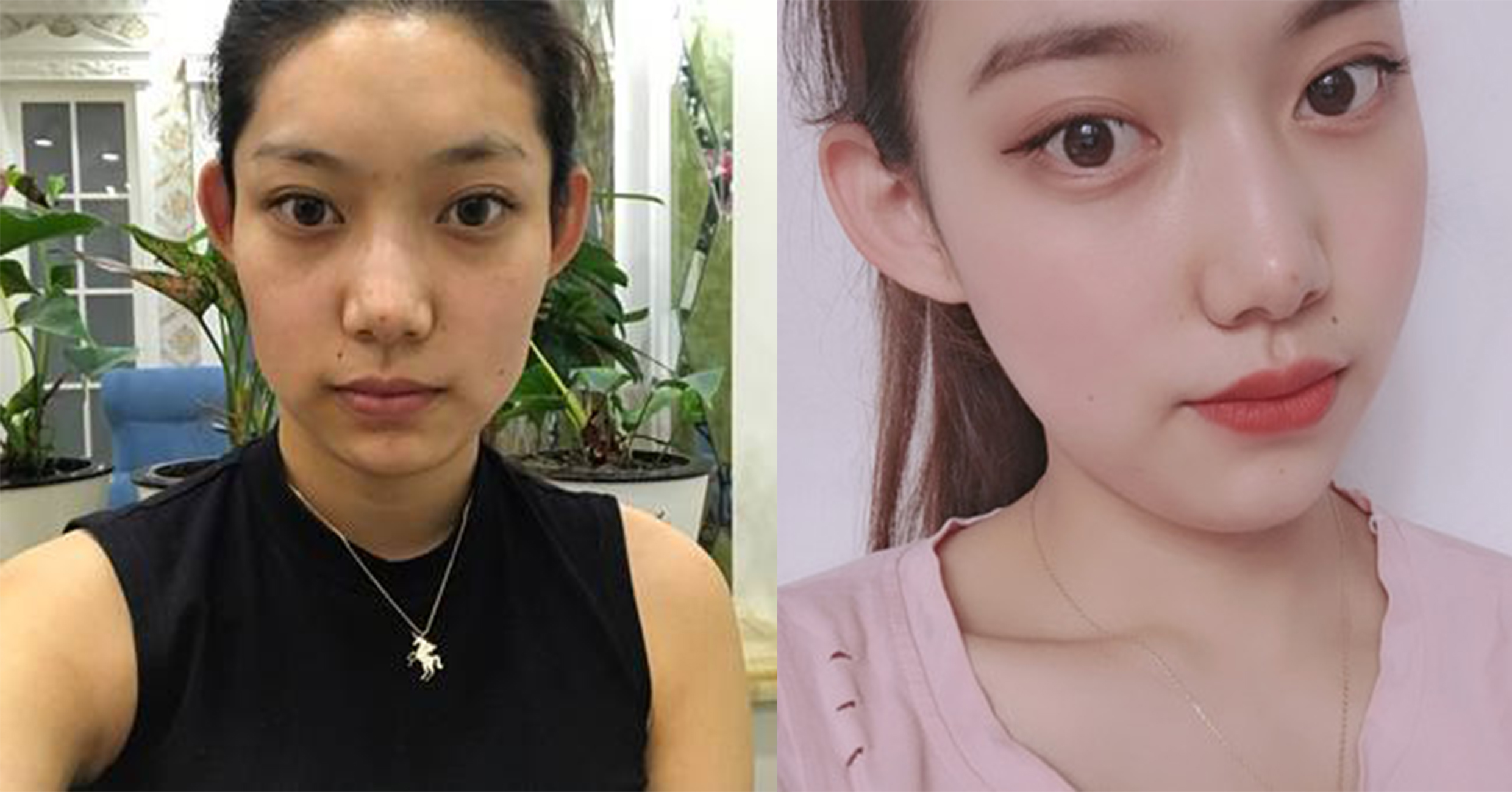 脂肪填充手術(shù)效果對比4