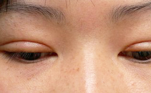 埋線雙眼皮失敗該如何修復(fù)？多久修復(fù)好？