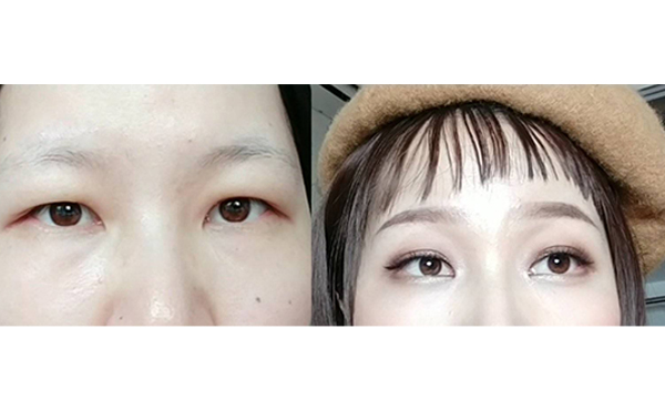 不同程度的三角眼如何改善?效果怎么樣?