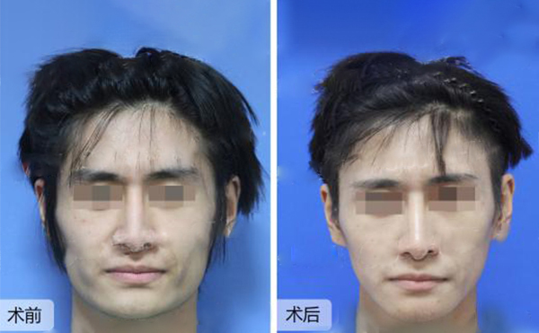 做下頜角整形風(fēng)險(xiǎn)有哪些？