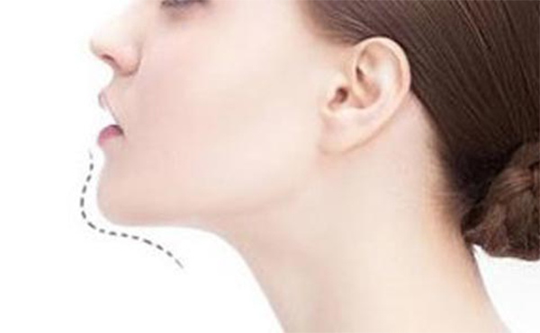 玻尿酸豐下巴好嗎？做玻尿酸豐下巴需要注意什么