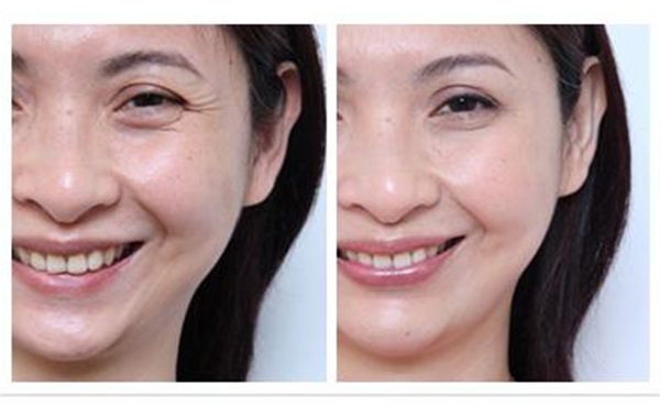 去魚尾紋多少錢？