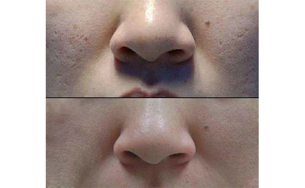 光子嫩膚適合哪個(gè)年齡段？