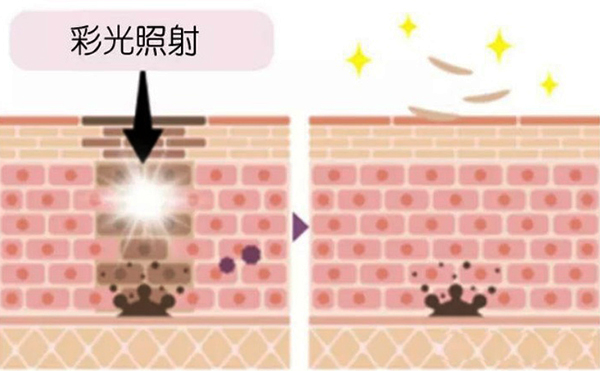 彩光嫩膚和光子嫩膚有什么區(qū)別?怎么選擇?