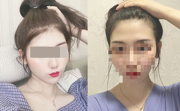 冰點脫毛后多久可以洗澡嗎？