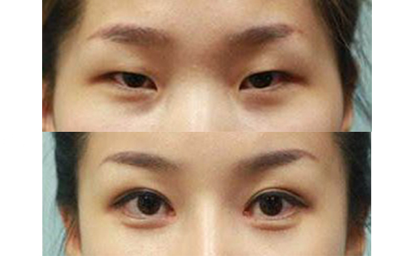 眼綜合手術(shù)多久能恢復(fù)自然？