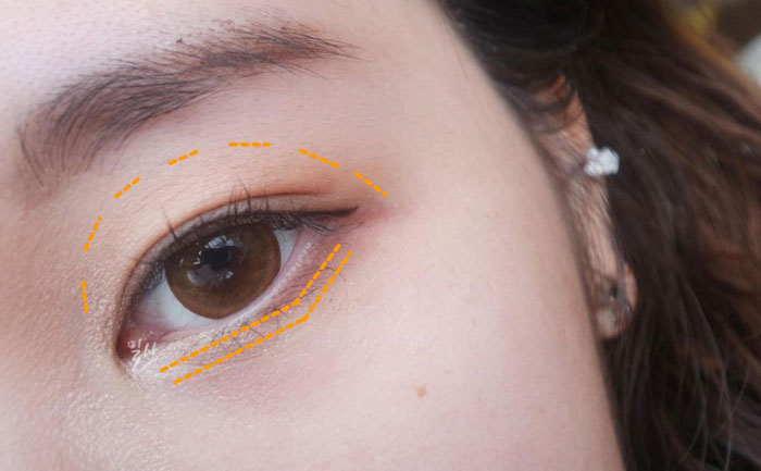 眼窩自體脂肪填充多少錢(qián)？自體脂肪豐眼窩成活率高嗎？