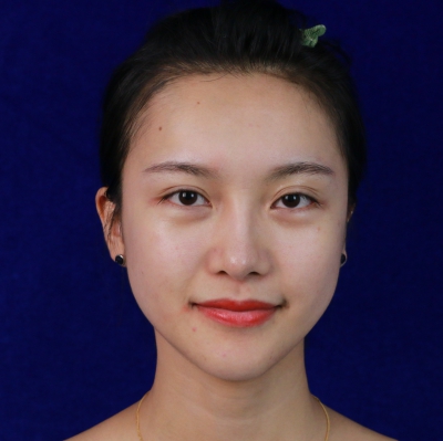 術(shù)前眼綜合照片