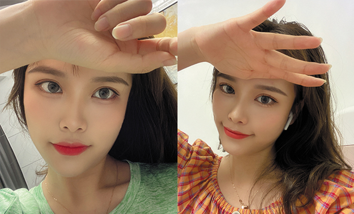 埋線提升案例效果對比圖3