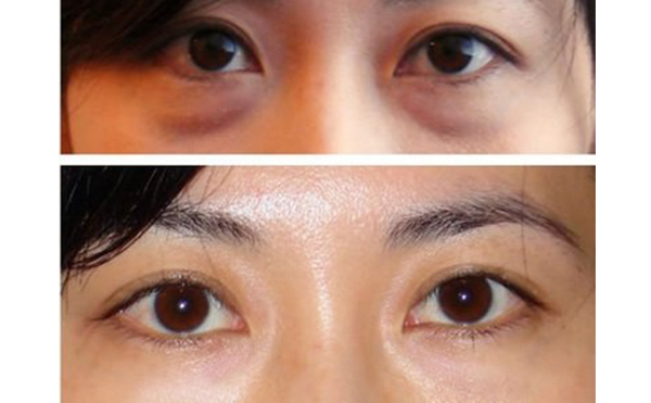 眼袋抽脂的手術(shù)過程是什么？