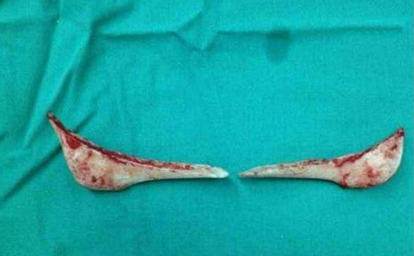 下頜角整形口內(nèi)切口和口外切口哪種方式更好？