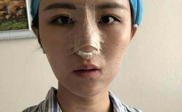 隆鼻怎么檢查失敗?根據失敗情況應該怎么處理?