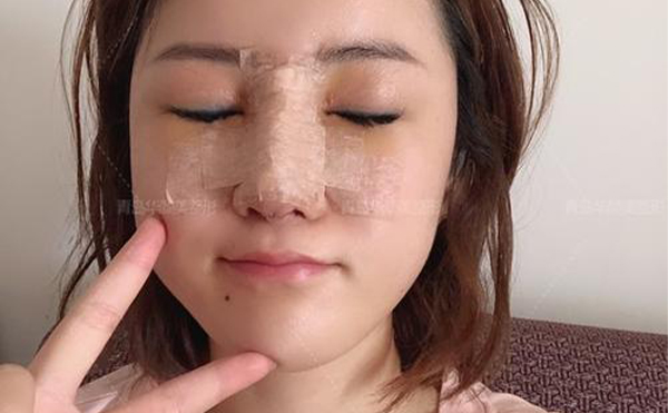 以注射隆鼻和假體隆鼻為例，如何確定隆鼻失敗