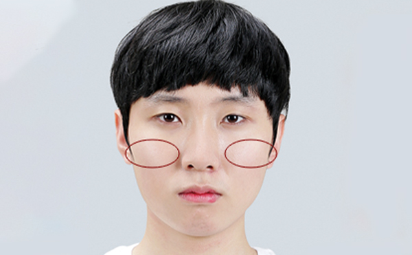 什么樣的顴骨建議做顴骨整形?術(shù)后護(hù)理要點(diǎn)有哪些?