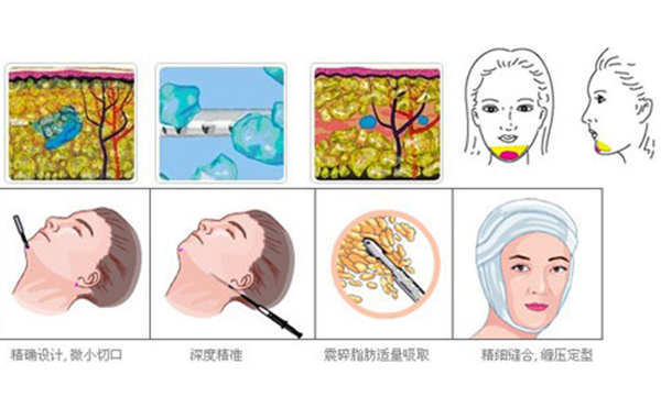 面部吸脂手術(shù)過程是什么？