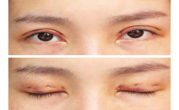 韓式三點雙眼皮是不是永久的?雙眼皮術(shù)后不對稱怎么辦?