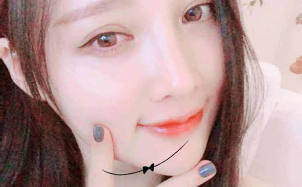 北京聯(lián)合麗格下頜角整形案例術(shù)后一年