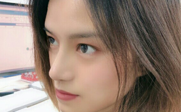 隆鼻術(shù)后一個(gè)月