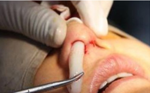 假體隆鼻術(shù)后為什么會(huì)發(fā)生假體移動(dòng)的情況？如何避免這類情況的發(fā)生