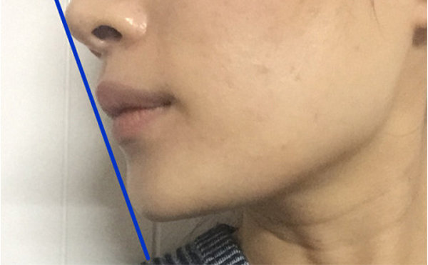 做假體墊下巴恢復后會被摸出來做過嗎？還能打玻尿酸嗎？