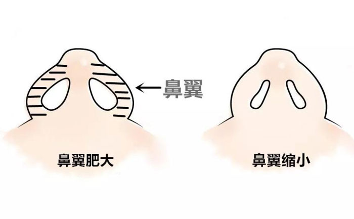 鼻翼縮小手術(shù)要做多久？