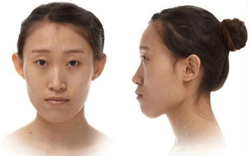下巴突出是什么原因引起的？下巴突出側(cè)面很難看怎么矯正？