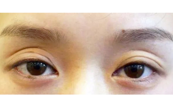 上眼皮凹陷怎么恢復(fù)飽滿?能維持多久?