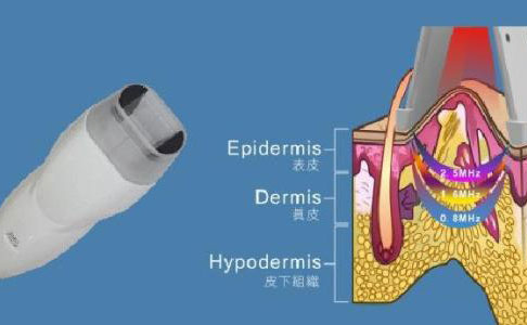 射頻除皺的效果好嗎？