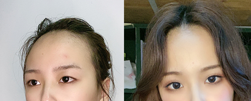 蘭州亞韓做雙眼皮案例對(duì)比圖