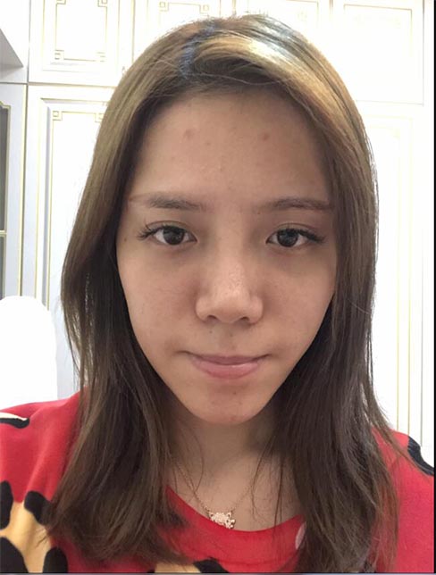 肋軟骨鼻綜合案例：術(shù)前效果